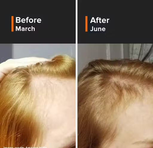 Minimalist Hair Growth Actives 18% Serum – Reduces Hair Fall & Promotes Thicker Hair | 30ml